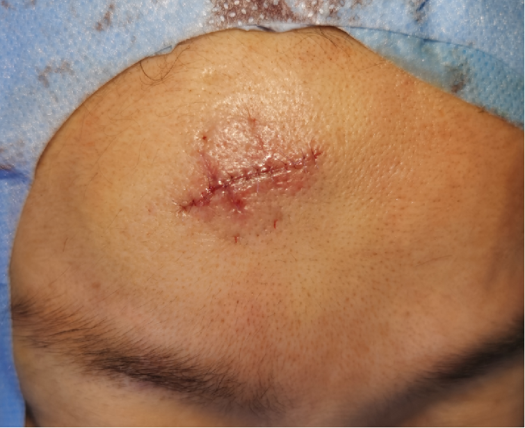 杨东运医生 的想法: 粗糙缝合拆线后9天(图1)我们就进行了切… - 知乎