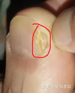 大脚趾灰指甲初期图片