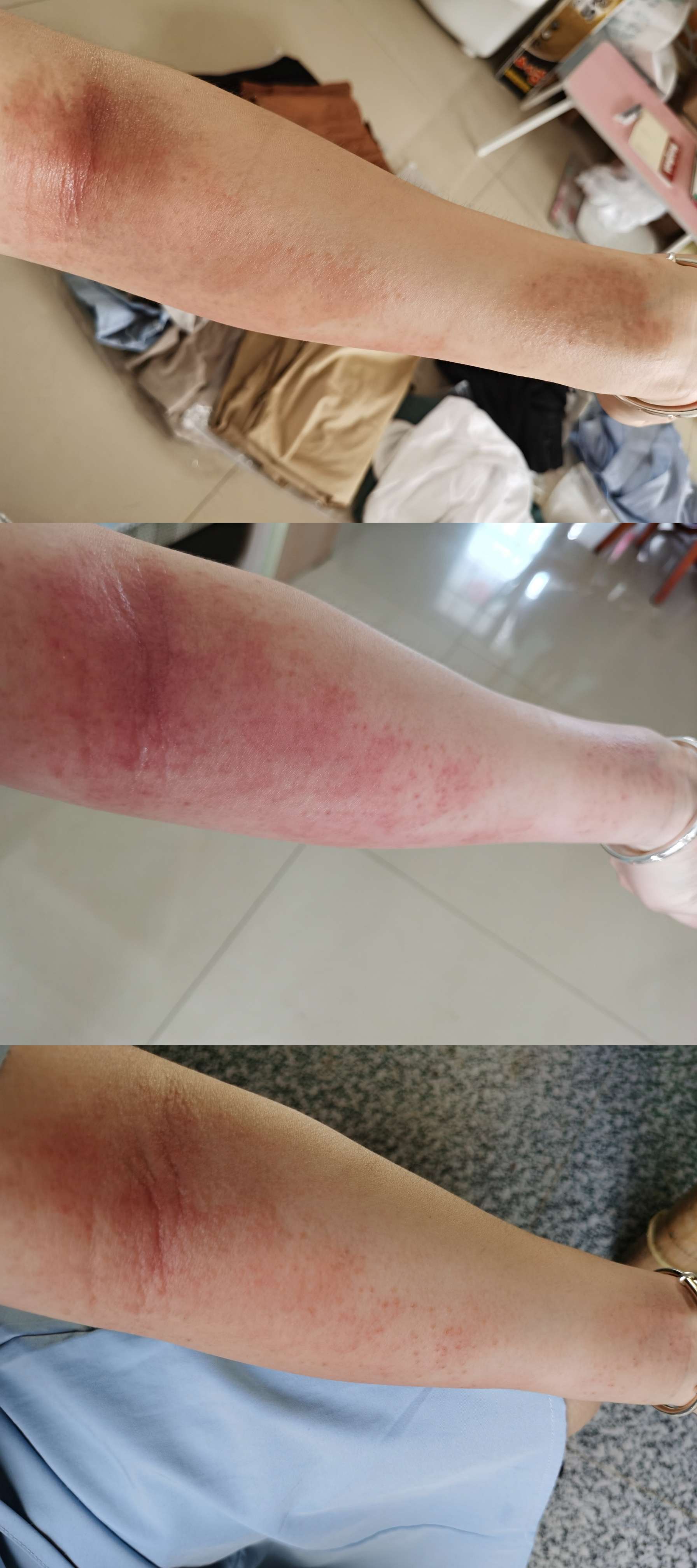前段时间手臂过敏现在疤都还没消手指半截又突然肿起来哎熬过几天再去