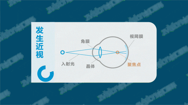 OK镜使用指南：孩子何时能告别它，走向激光手术？