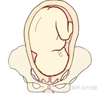 什麼是胎位不正對分娩有哪些影響