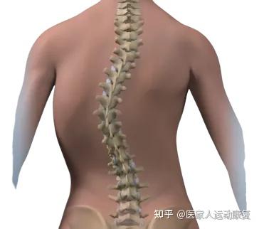 脊柱侧弯四十多度没有任何疼痛到底需不需要手术