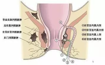 广州东大肛肠医院黑吗肛瘘（肛漏）：你了解它么？