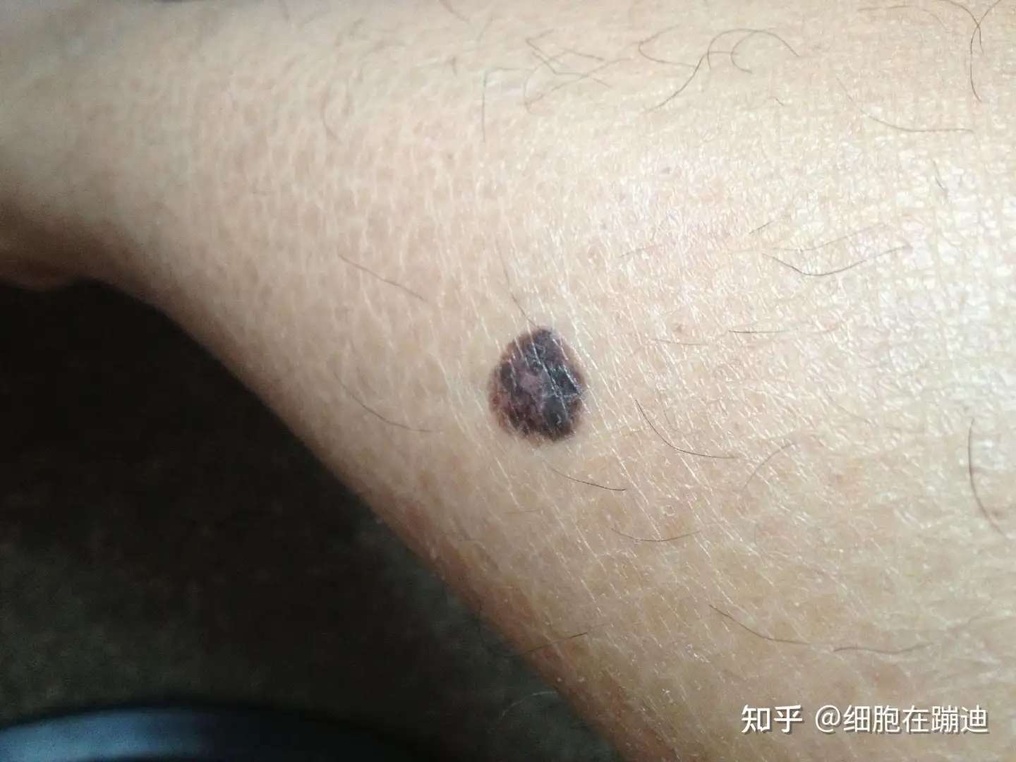 25 岁女孩确诊黑色素瘤仅 5 个月离世，这是一种什么病？为什么会这么严重？