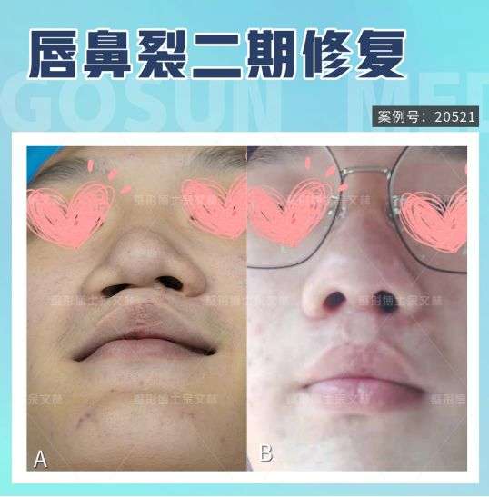 唇裂孩子为什么鼻子也塌了?专家提醒这个年龄快去修复!