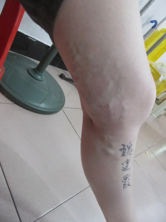 泉州成功医院正规吗？静脉曲张的原因有哪些