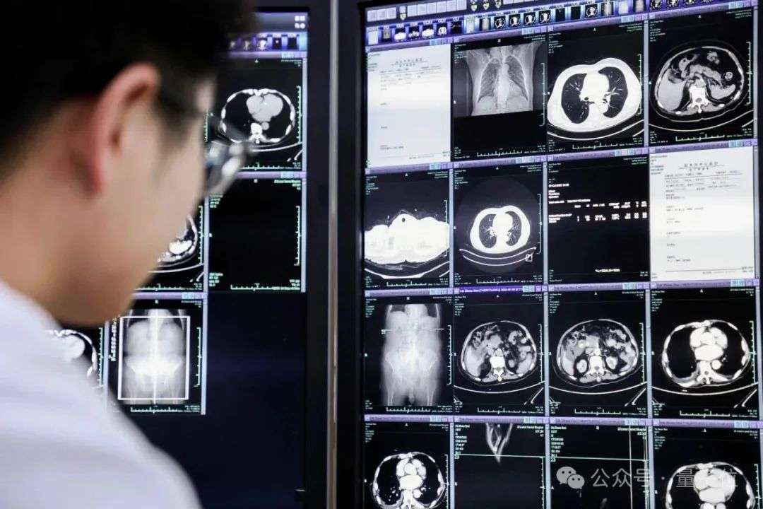这个AI能救命！提前6个月发现胃癌病灶，突破医学影像认知，达摩院做成了
