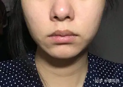 为什么嘴巴两边嘴角会有凸出来的肉肉看整体面相的话比看这个局部更