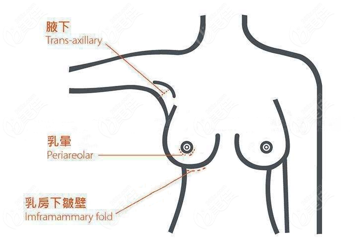 假体隆胸前后图片