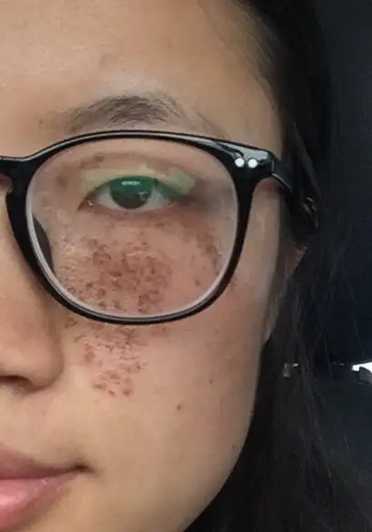 我脸上的雀斑样痣,只分布在左脸,去医院做过两次激光治疗,但一两年