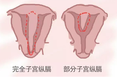 纵隔子宫术后成功受孕：彭雪冰医生助孕案例分享