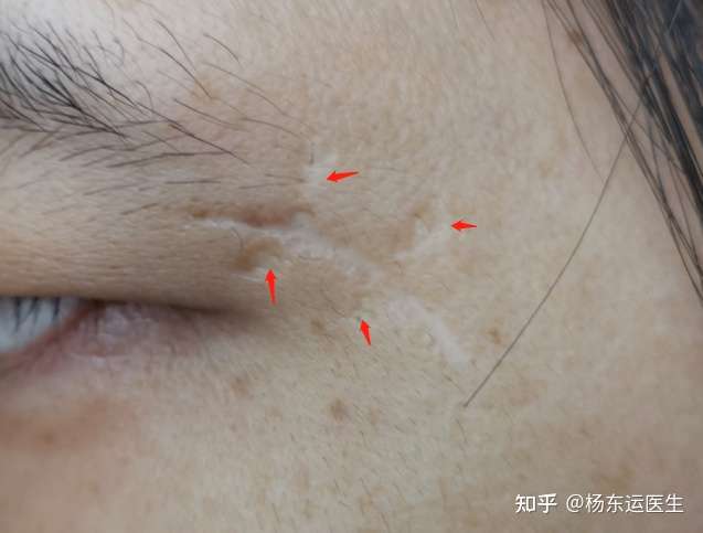 真的很讨厌这种蜈蚣脚疤痕处理很棘手