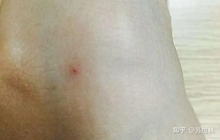 为什么手上突然长小红点? - 知乎 为什么手上突然长小红点? - 知乎