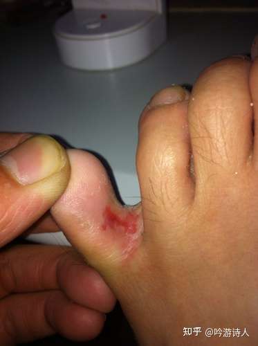脚趾开裂,脱皮比较厉害? - 知乎