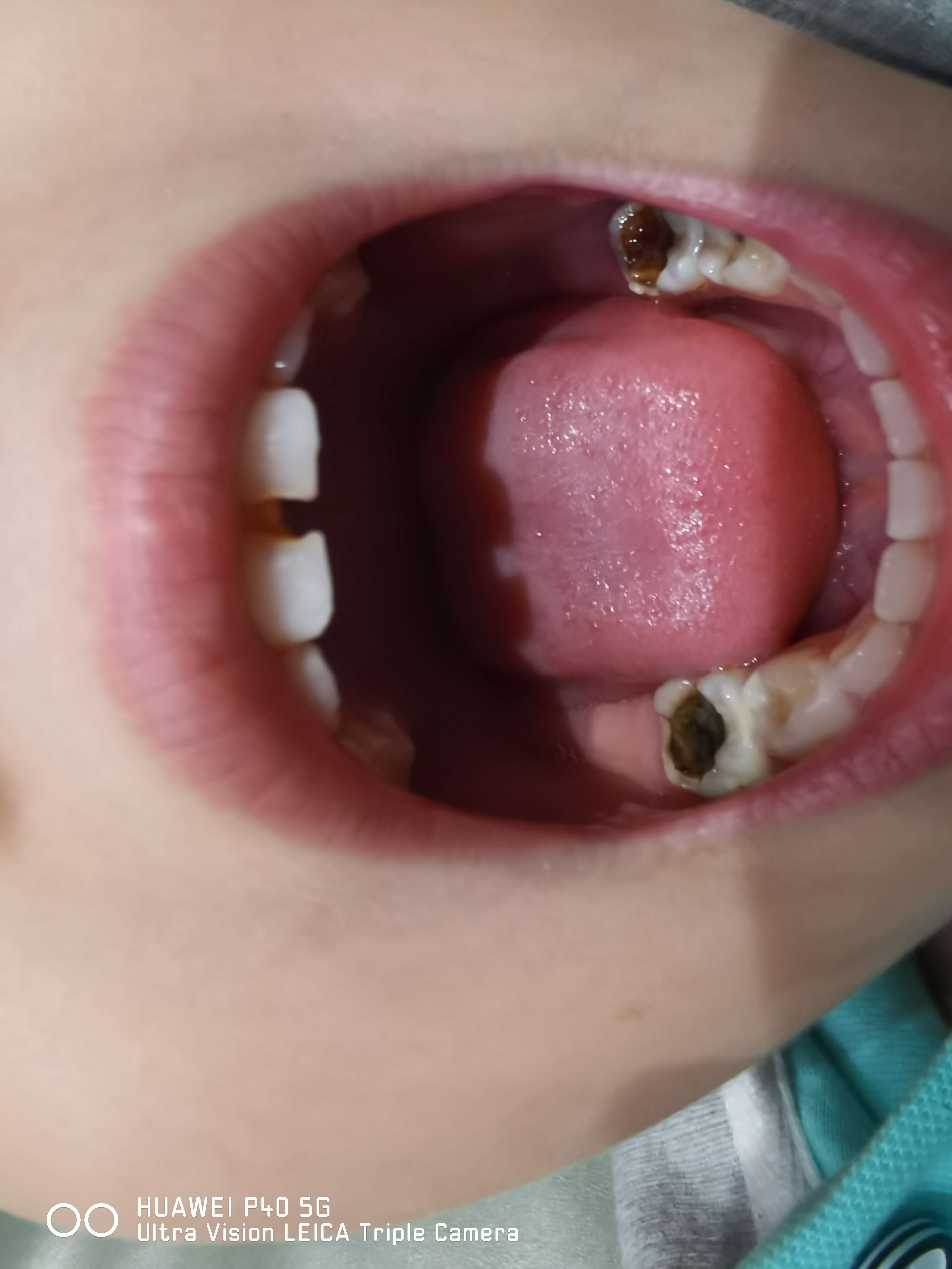 经年 的想法: 三岁娃,牙齿发黑有洞,应该去牙科医院还… 