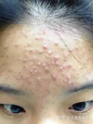 闭口痘痘怎么去除? - 知乎