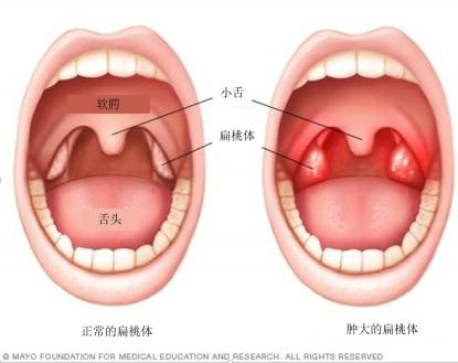 妙手仁心驱病痛：苏州儿童医院李大伟医生治疗小儿扁桃体肥大