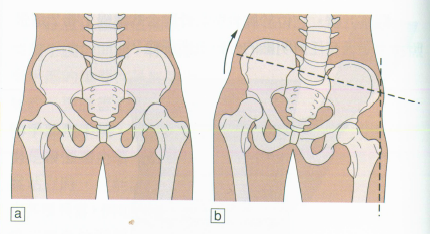 骨盆侧倾怎么改善?原理是什么? - 知乎