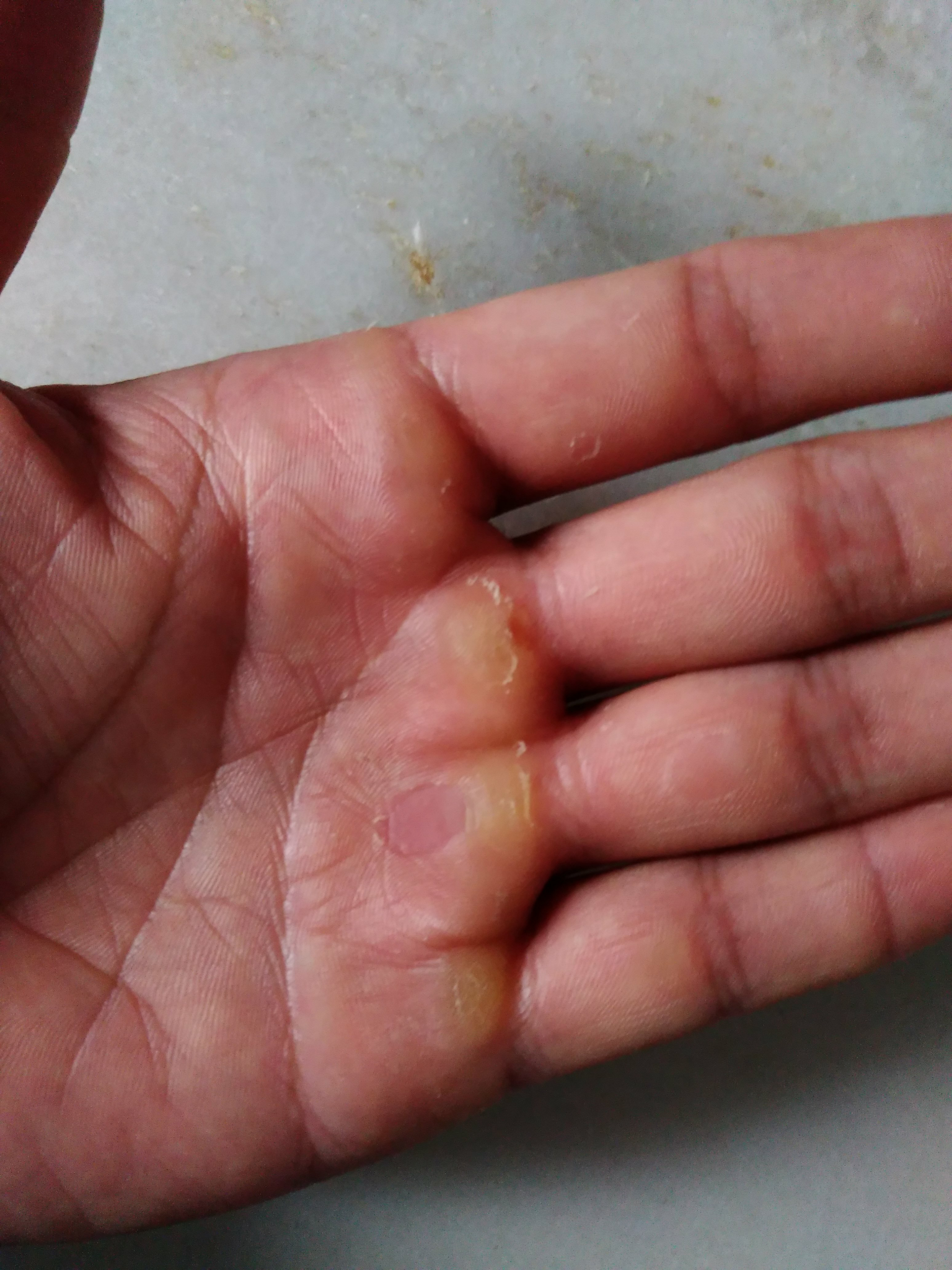 上器械后,手上全是血泡,有好方法避免或快速恢复吗? - 知乎