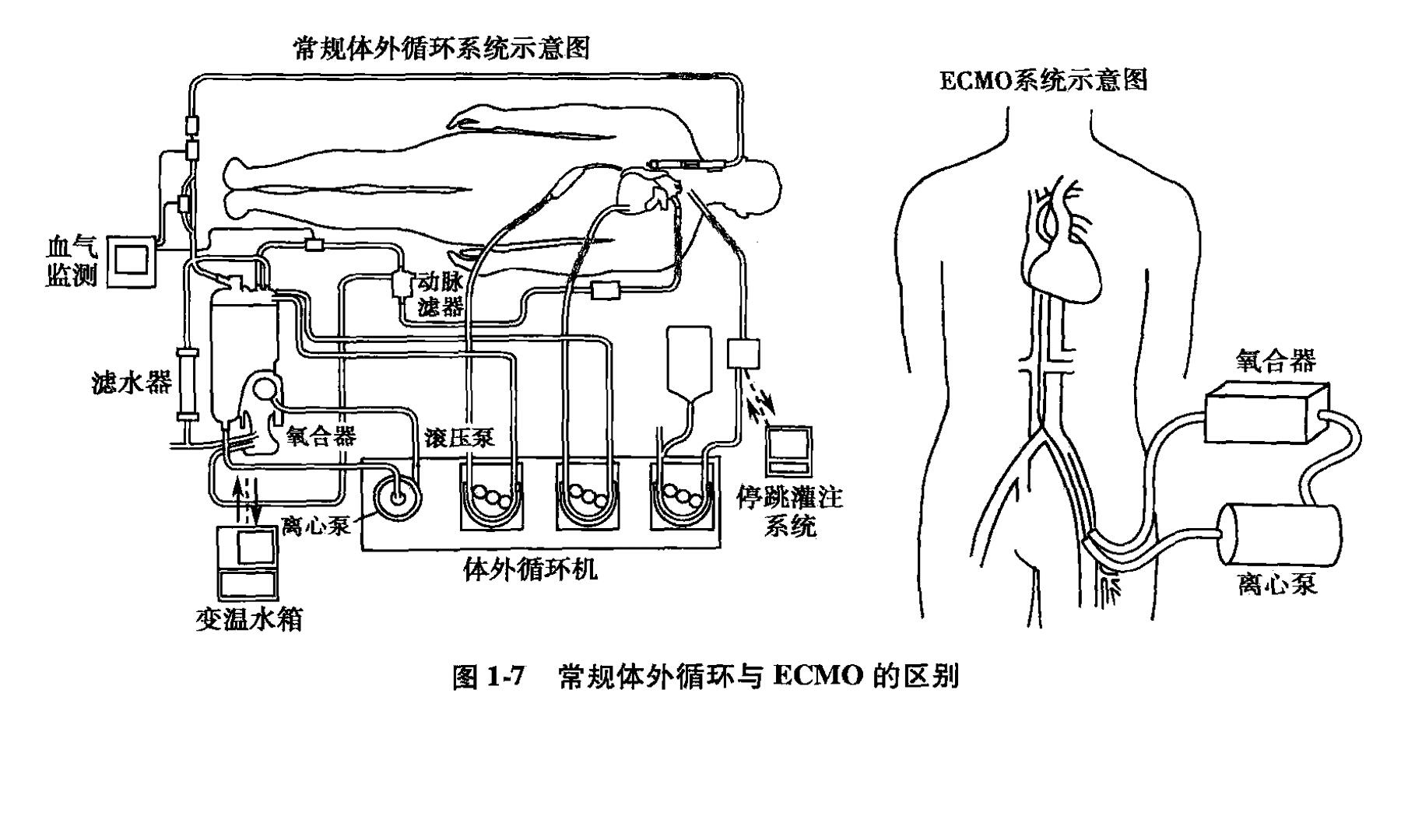 ecmo管路示意图图片