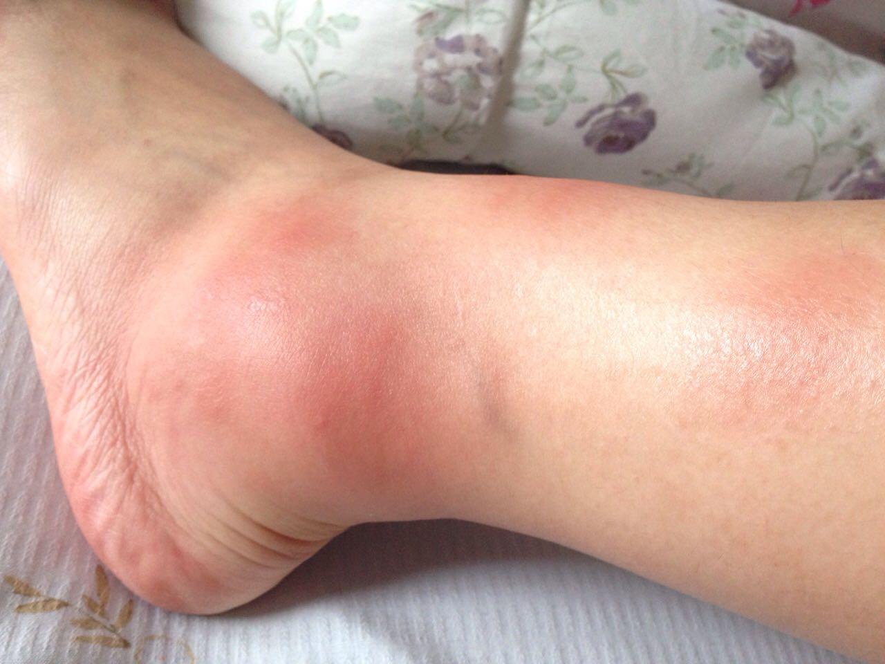 貌似被白纹伊蚊咬了会出事吗