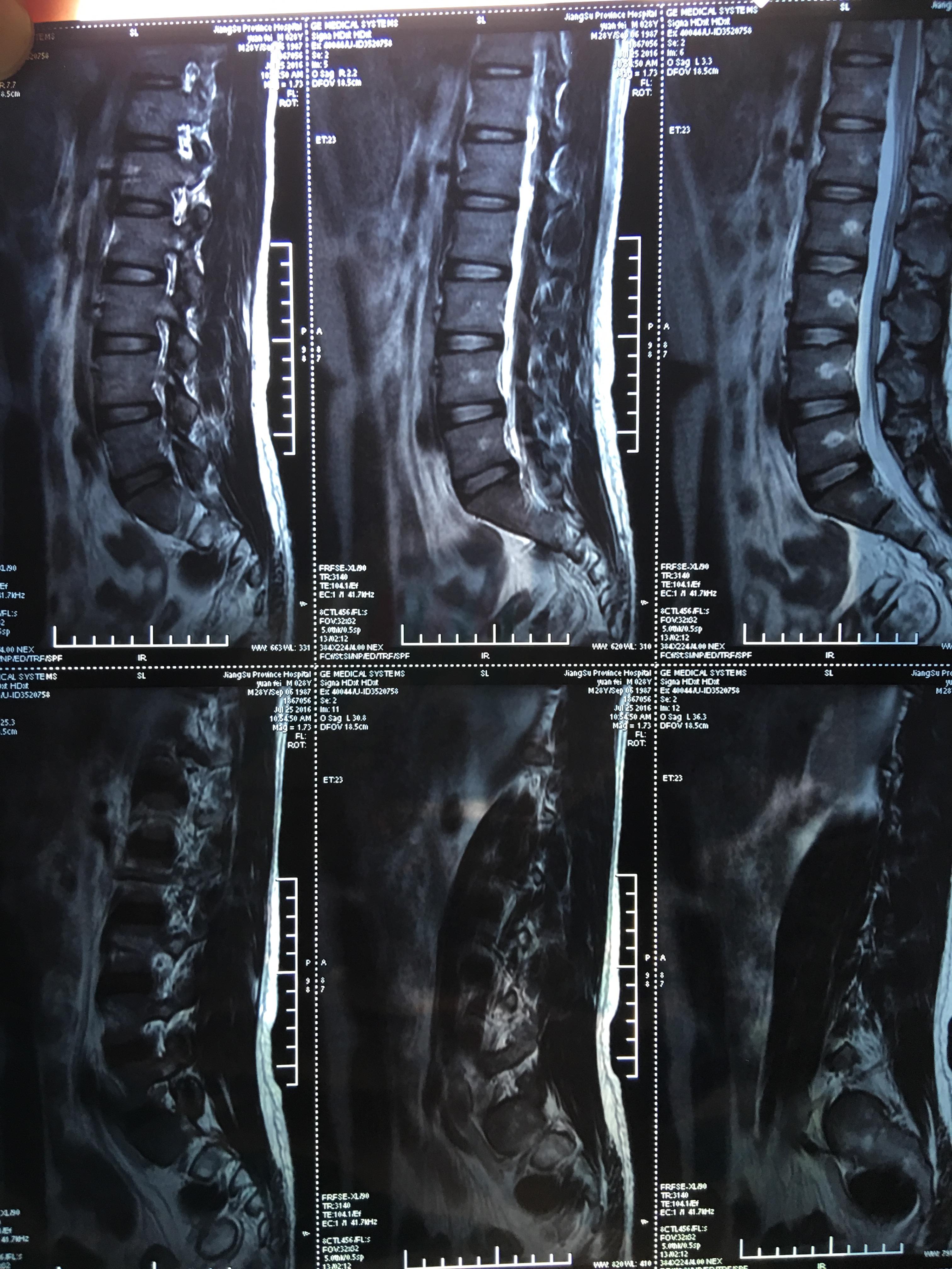 影像报告的腰椎间盘突出与腰椎间盘突出症不是一回事