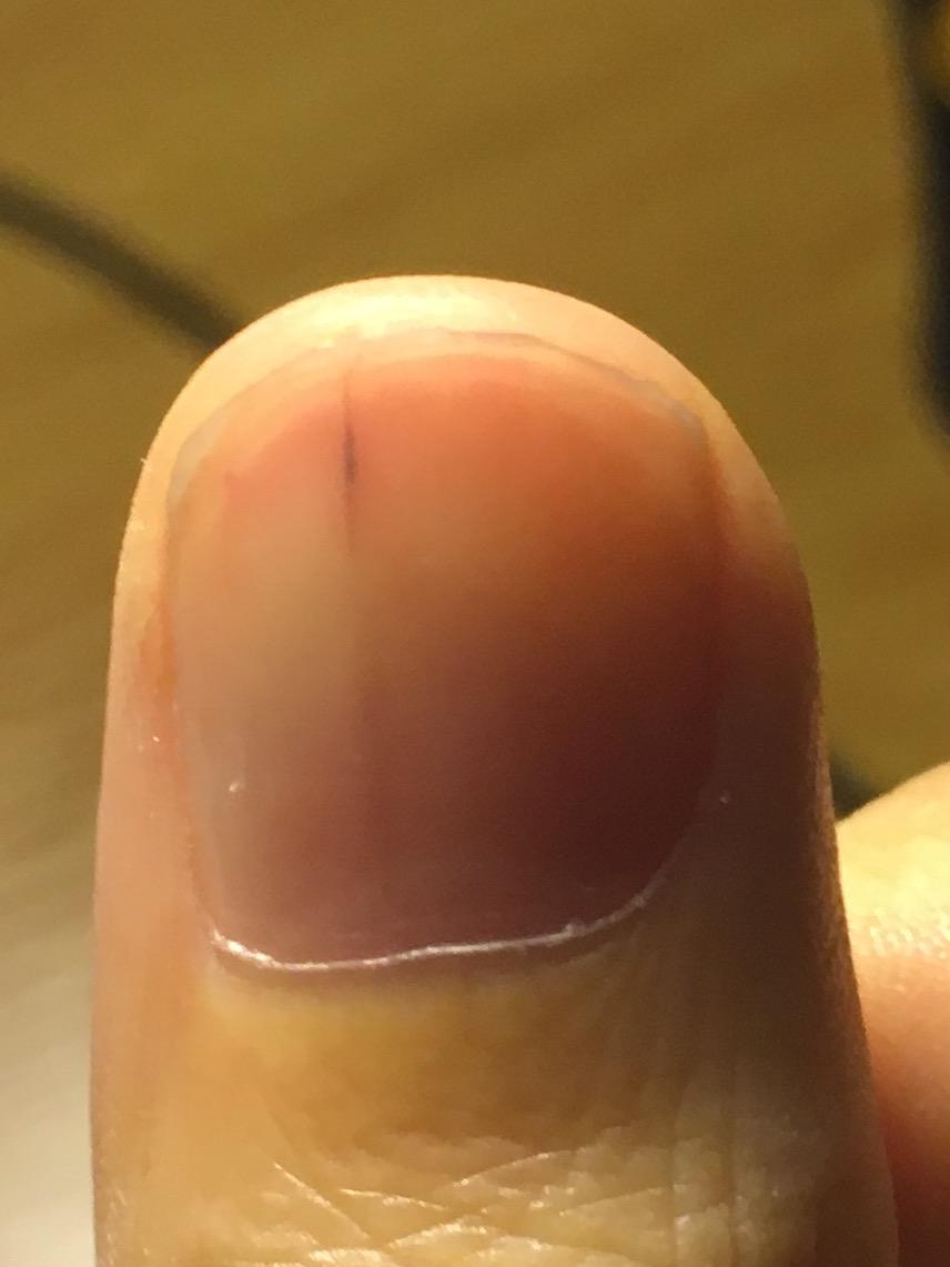 指甲上有一条淡淡黑线,怎么回事?两年了 