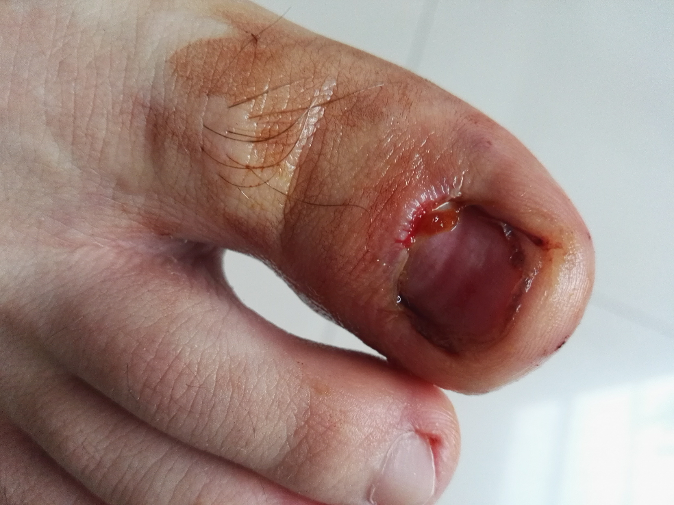 拔指甲是什么样的体验?很疼么? - 知乎