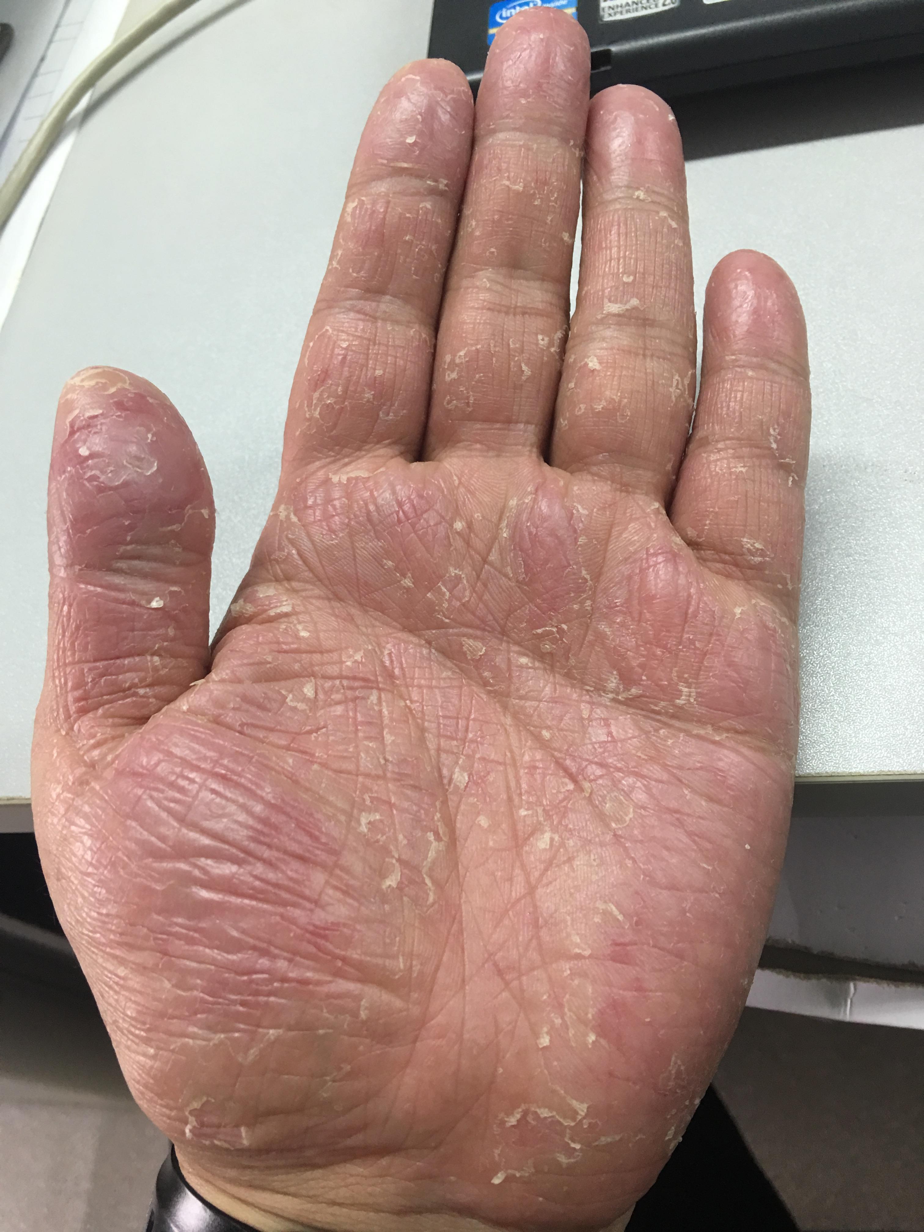 季节性手脱皮,什么原因?有什么方法可以根治吗? - 知乎