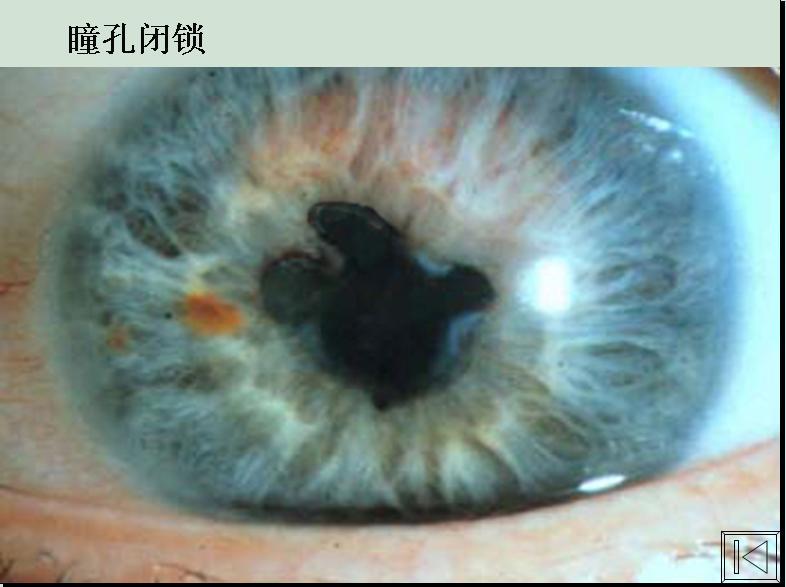 历史上的重瞳子是真实存在的吗?两个瞳仁在眼睛里是如何分布的? - 知乎