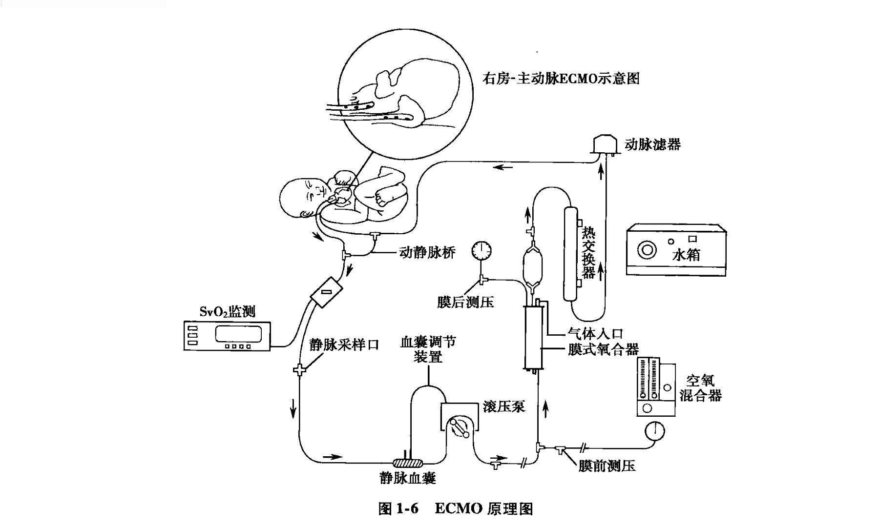 体外膜肺氧合ecmo的原理是什么较之于传统体外循环优势体现在哪些方面