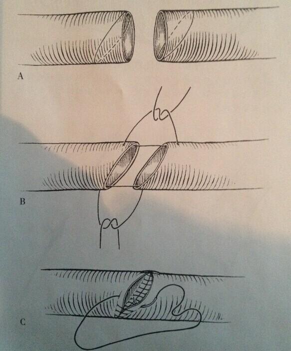 外科手术中如何缝合血管有哪些缝合方法