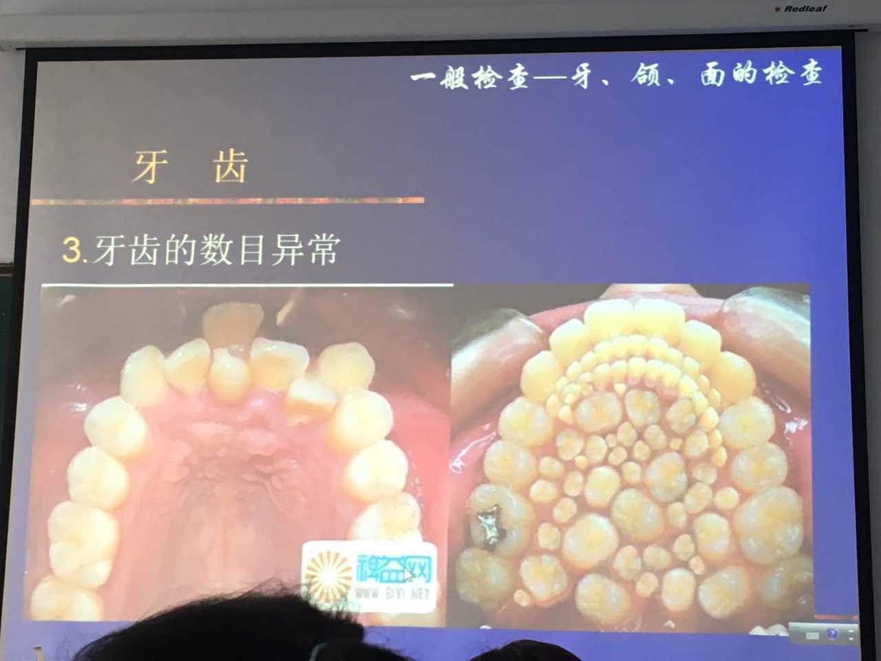 为什么上颚会长出牙齿