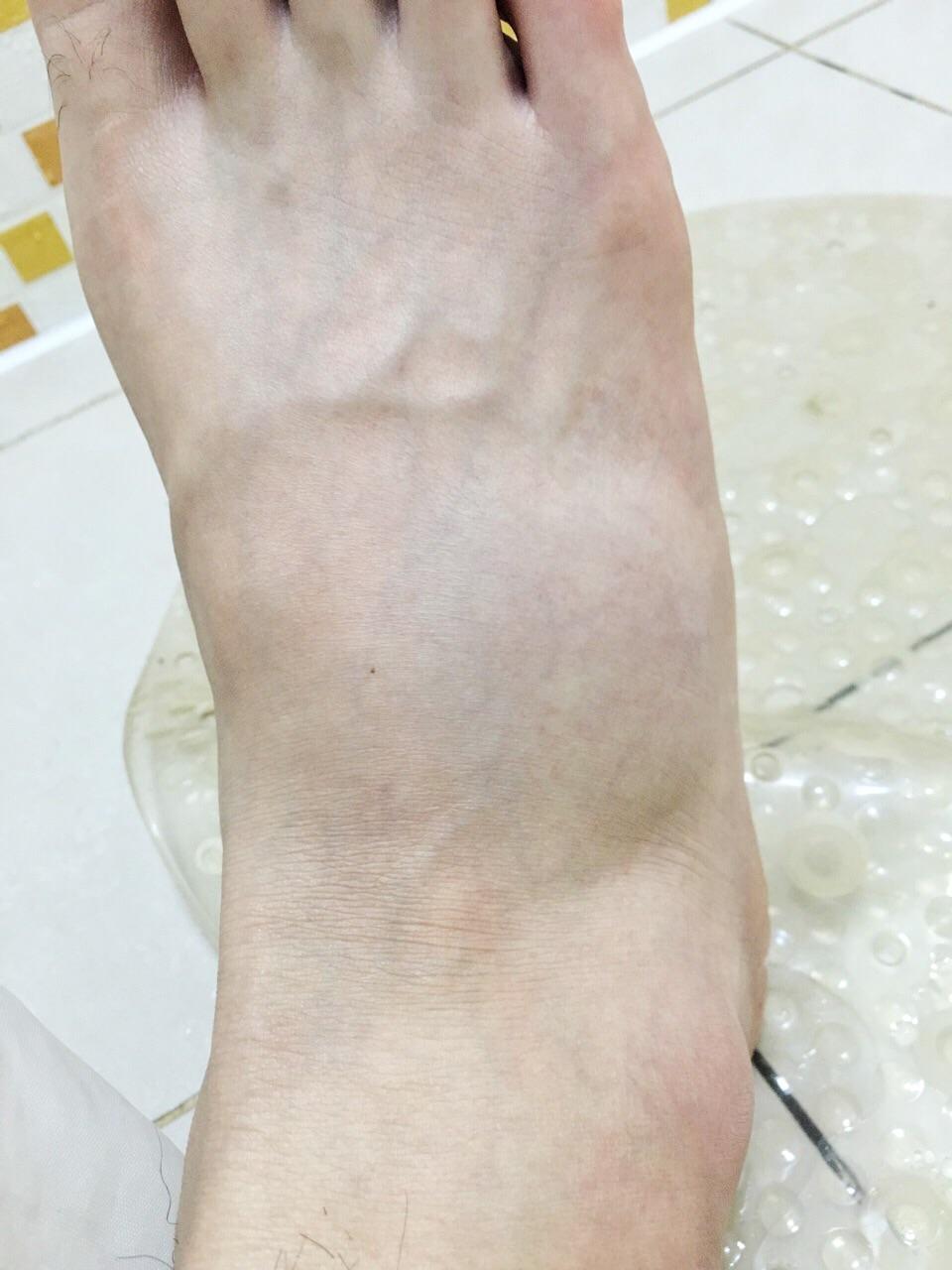 崴一脚骨折的可能性大么? - 知乎