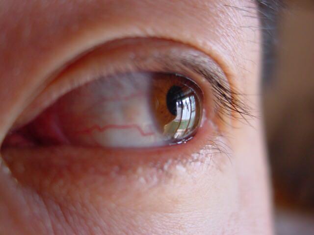 黑眼球和眼白之间的地方长了和小米粒大小的白点眼睛发炎三天照镜子时