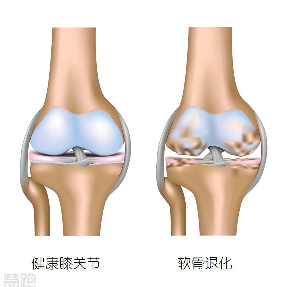 关节软骨的位置图片