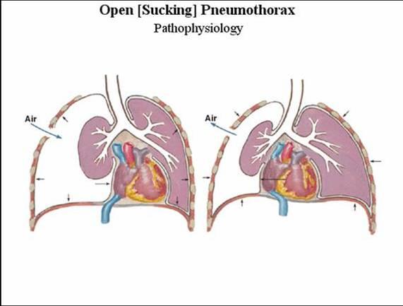 开放性气胸纵隔扑动图片