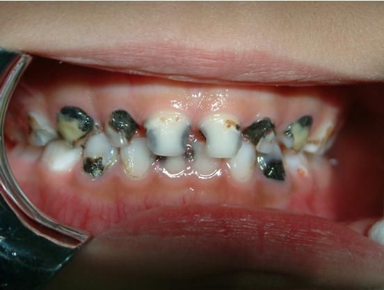 牙釉质发育不完全是怎么变成这样的?换牙会好吗?四岁半孩子? 