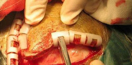 开颅手术的全部流程是怎样的