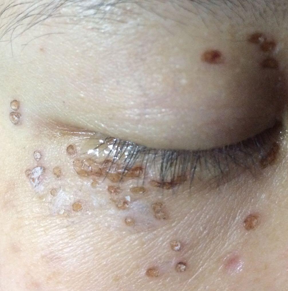 怎么治疗汗管瘤