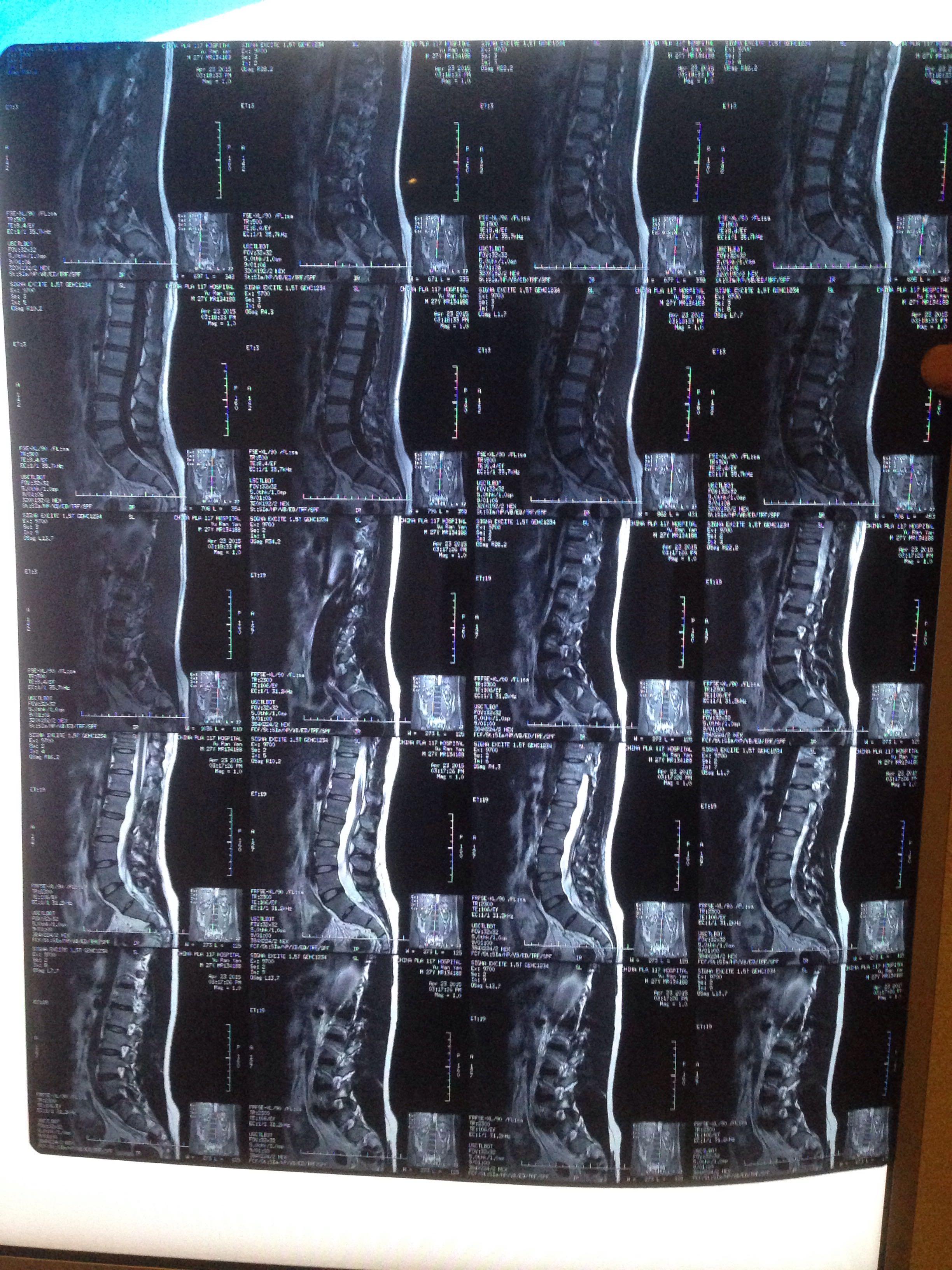 正常腰椎核磁共振图片图片