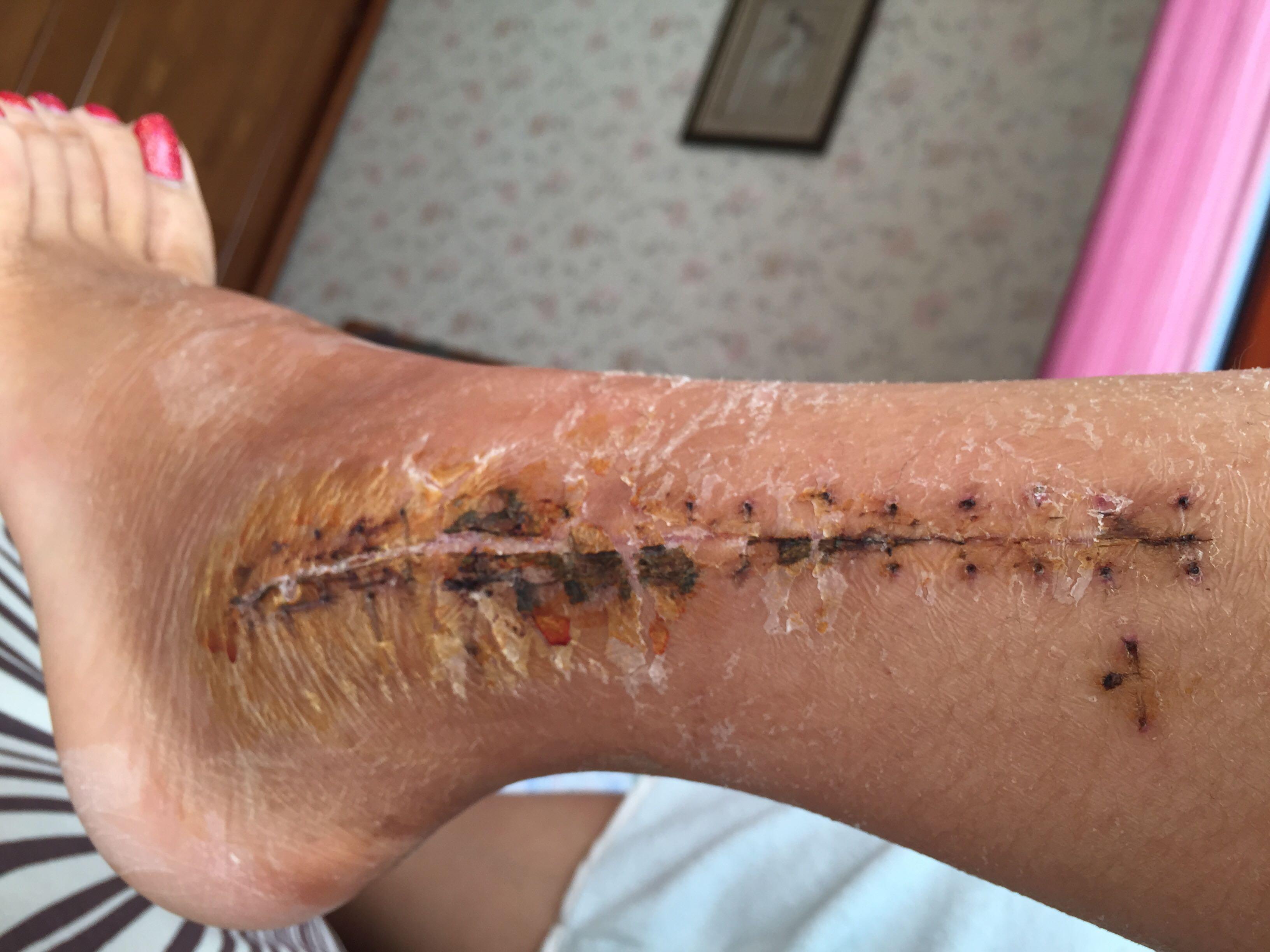 骨折手术后,伤口结痂可以水洗吗?