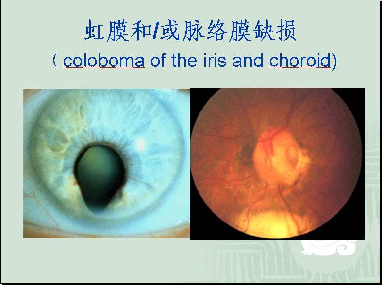 历史上的重瞳子是真实存在的吗?两个瞳仁在眼睛里是如何分布的? - 知乎
