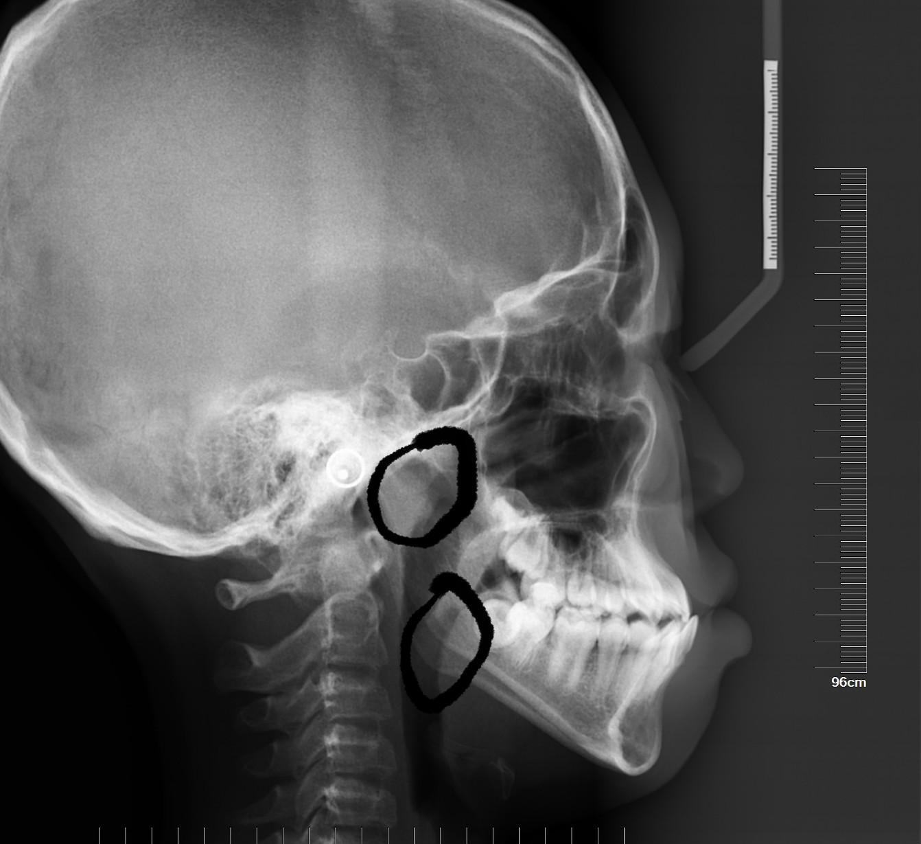 侧位片上可以看到患者是反合(地包天),而且扁桃体和腺样体肥大.