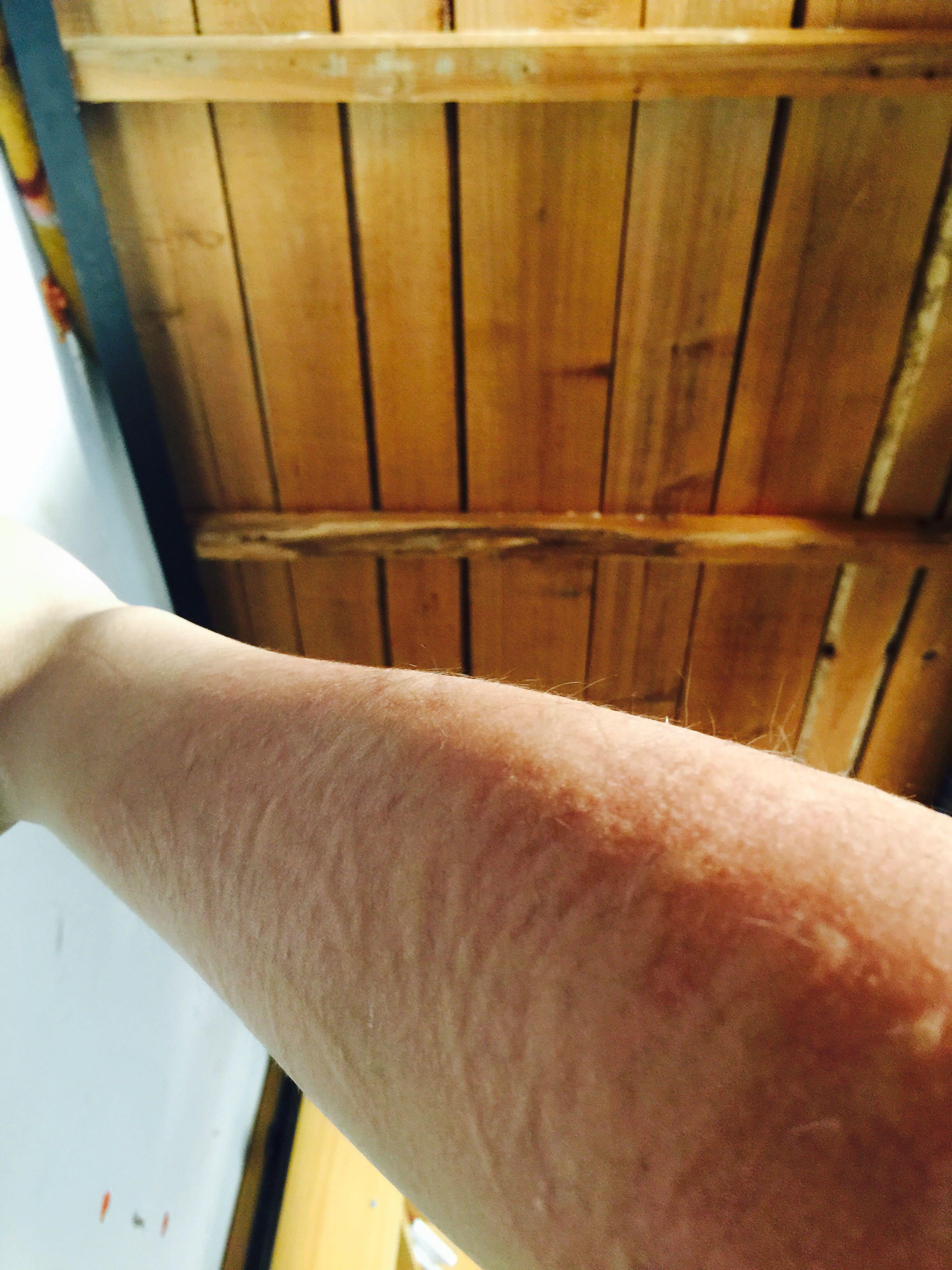 人工荨麻疹皮肤划痕症的原理是什么有治疗的必要么对人的影响大吗