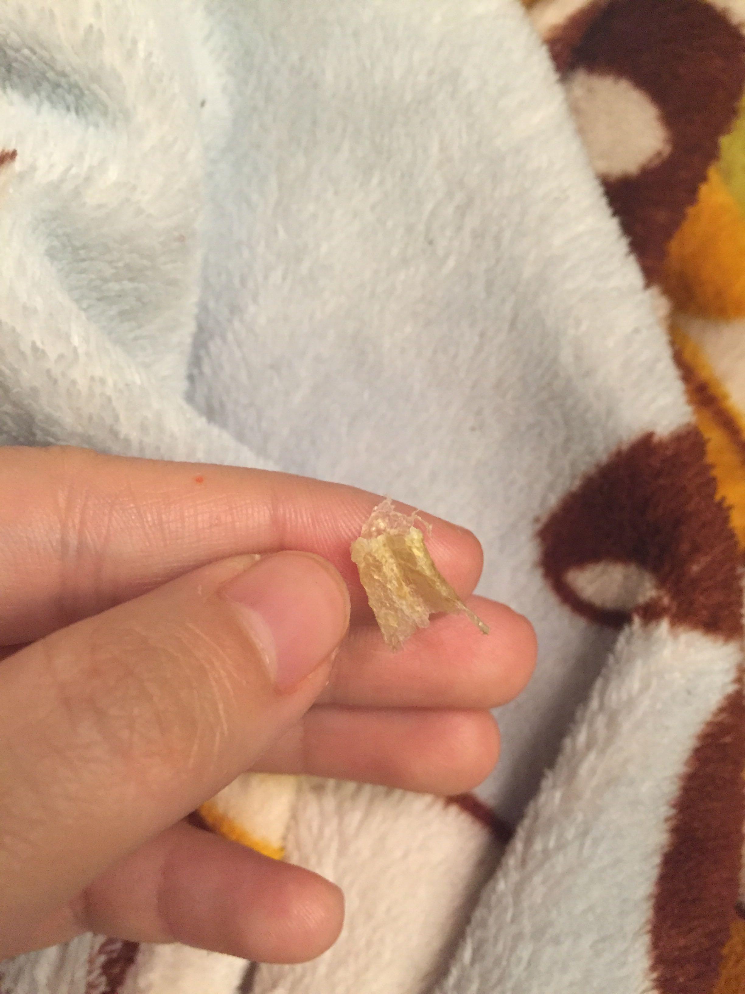 为什么我掏出来的耳屎是桶状的就是一层薄膜粘附在耳壁上