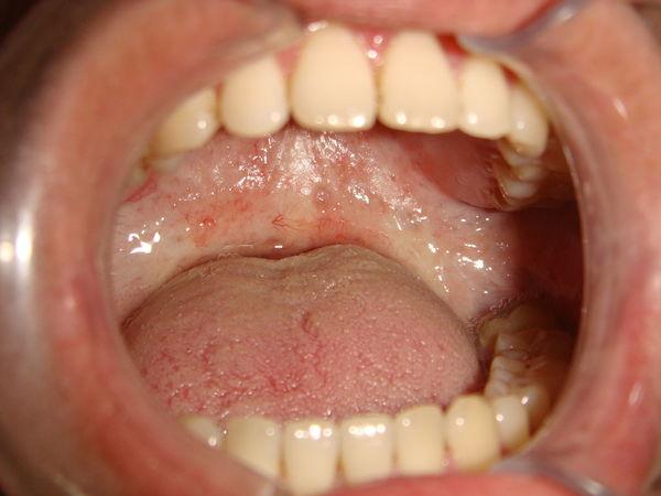 吃槟榔是怎么导致嘴「变小」的? - 知乎