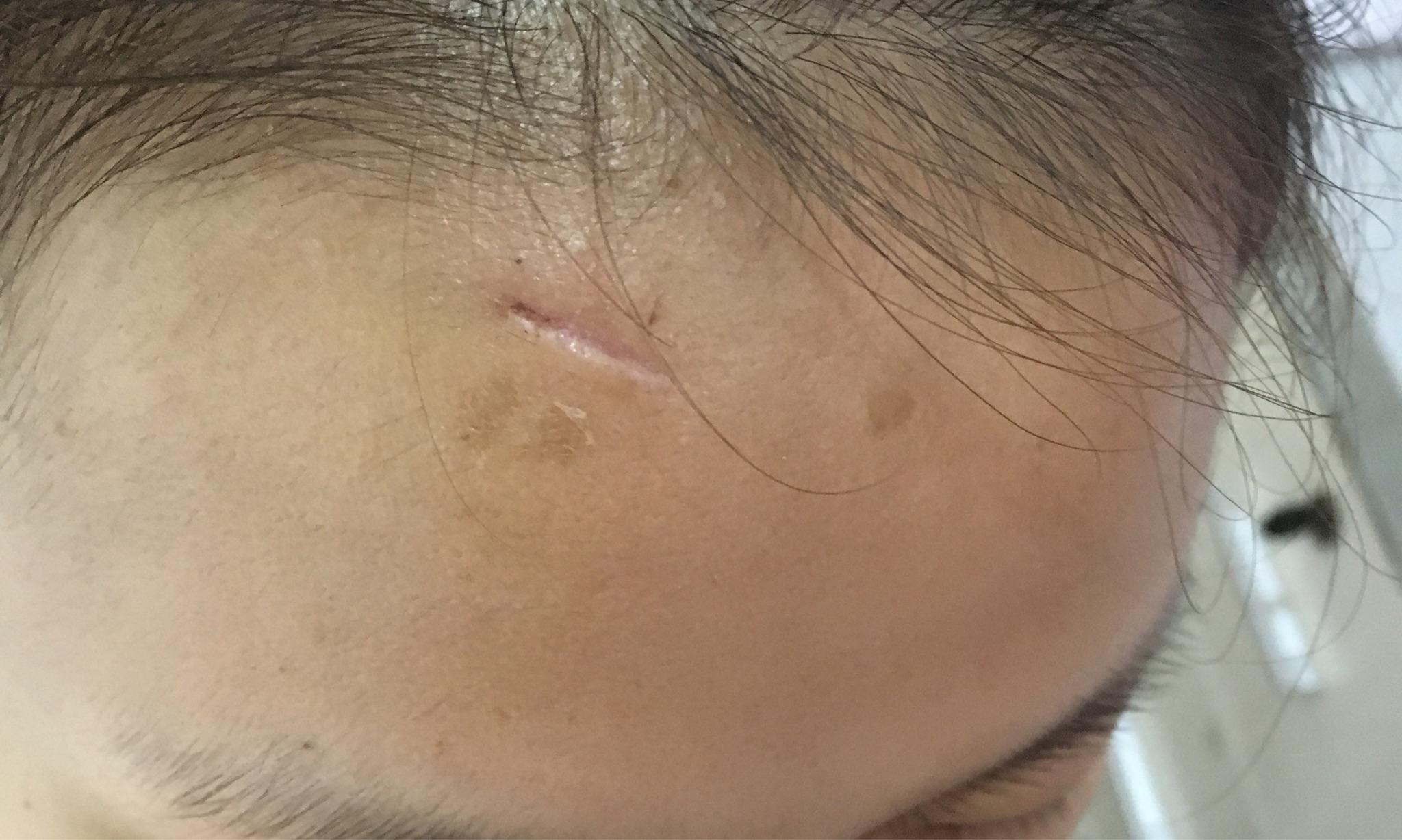 面部伤口掉痂后一直发红现在能擦药吗如何淡化疤痕