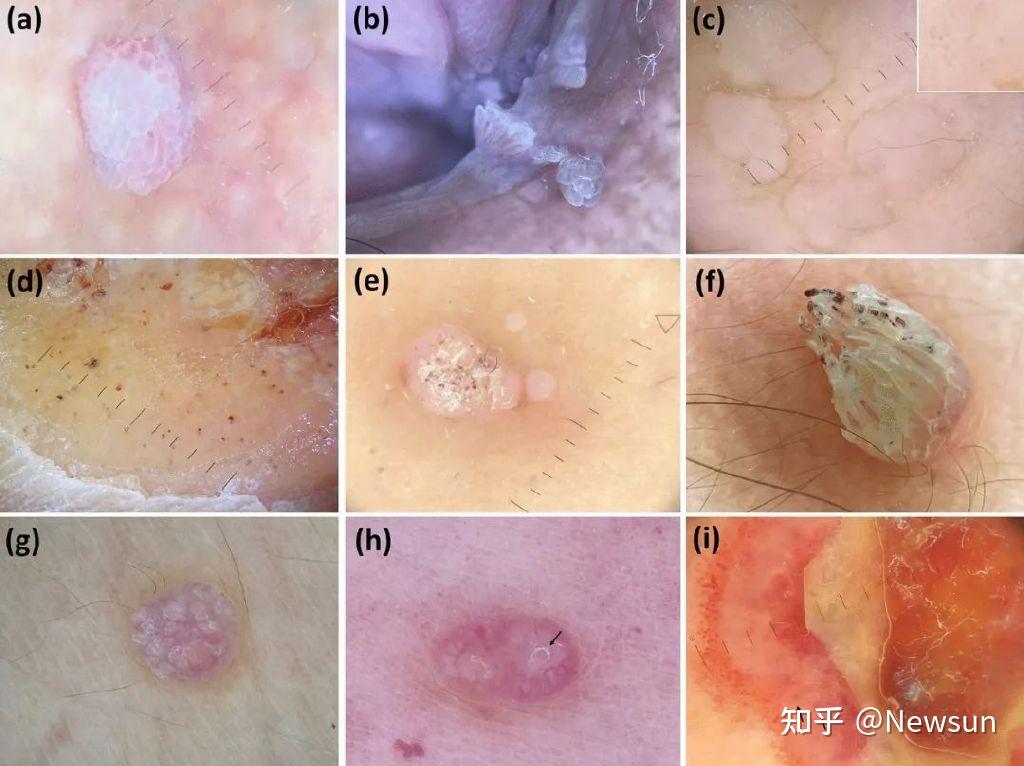 身上5种疣可能是hpv感染!