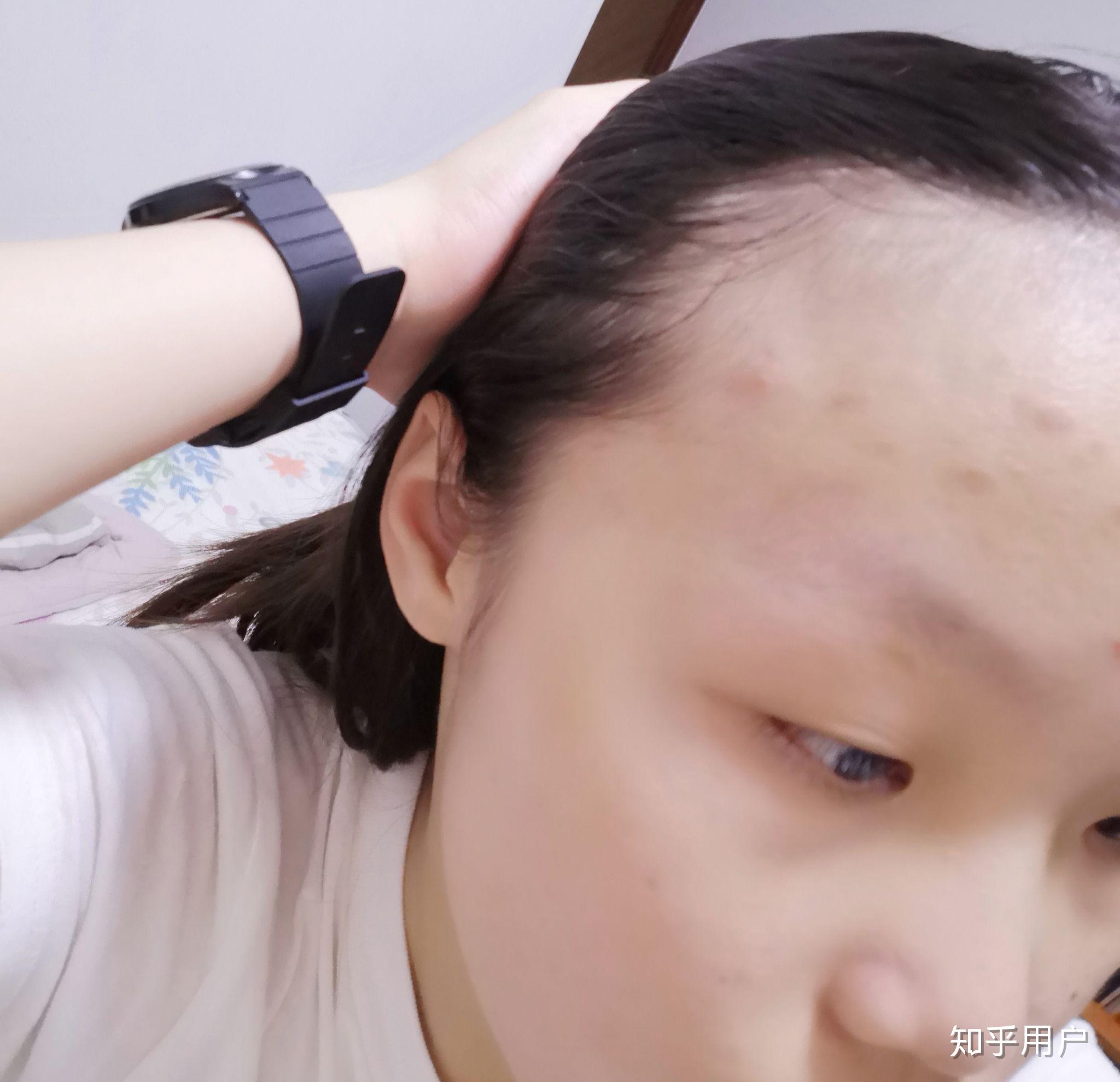 女生发际线特别高是怎样的体验